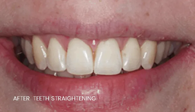 widnes teeth straightening results