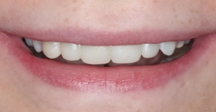 composite bonding widnes dentist