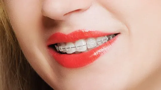 Read about Hayleys ceramic fixed braces teeth straightening treatment at Peellhouse Dental in Widnes Cheshire
